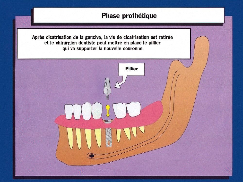 exposition implant dentaire Strasbourg